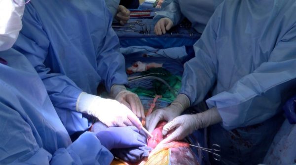Imagen del trasplante exitoso de riñones de cerdo a un hombre con muerte cerebral.