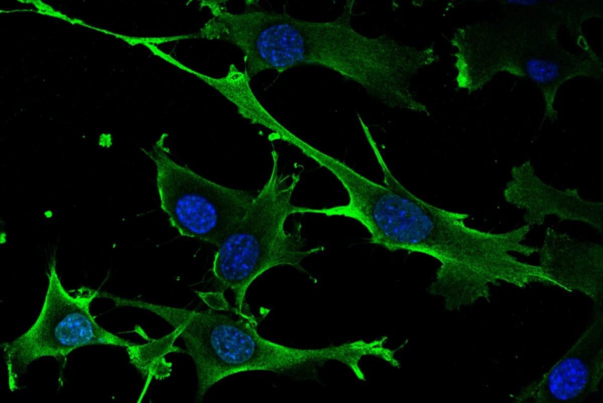 Descubren nuevo gen inductor de cáncer Diario La Hora