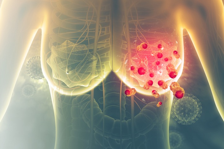 Incrementan la eficacia de la inmunoterapia en el cáncer de mama