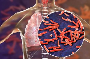 Esmeraldas, entre las 7 provincias  con mayor incidencia de tuberculosis