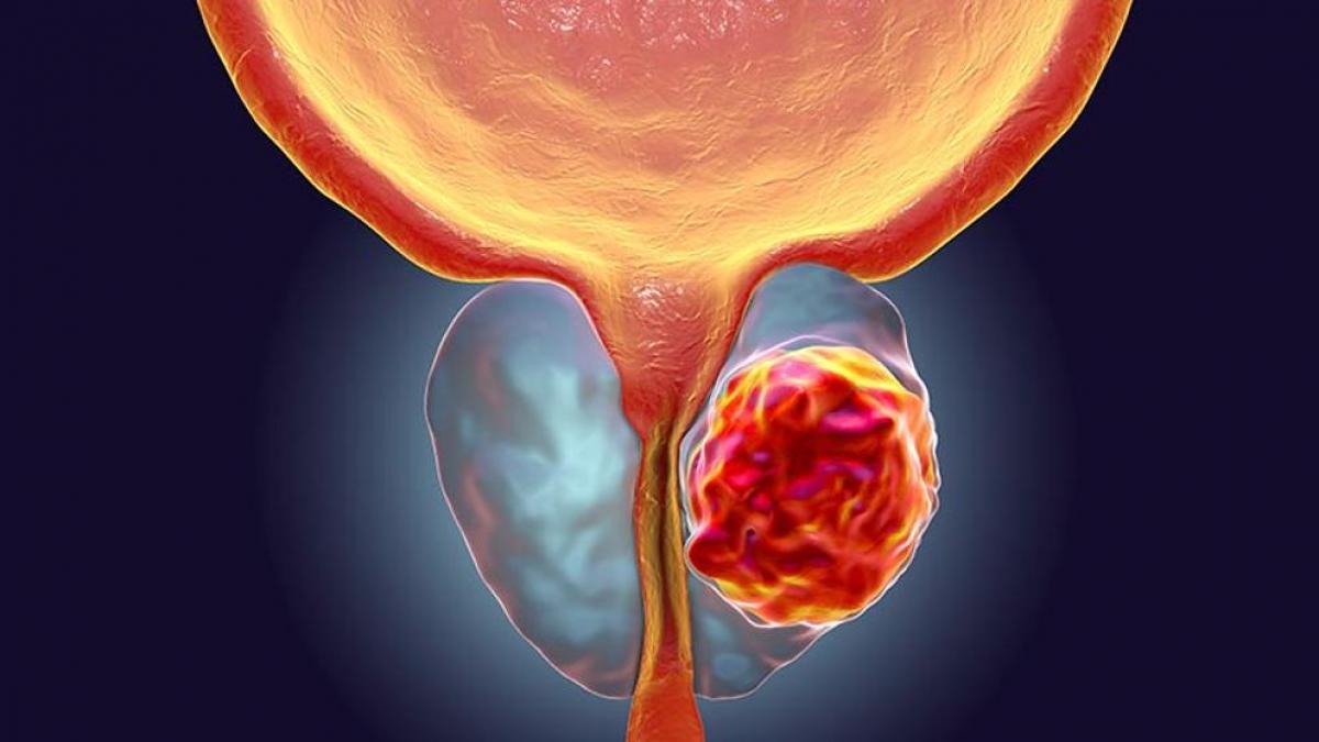 Importancia del examen de próstata después de los 40 años