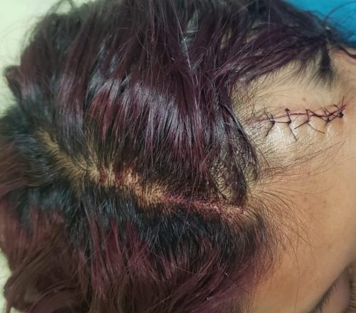 Las heridas de la mujer fueron suturadas y ella estabilizada en una casa de salud pública.