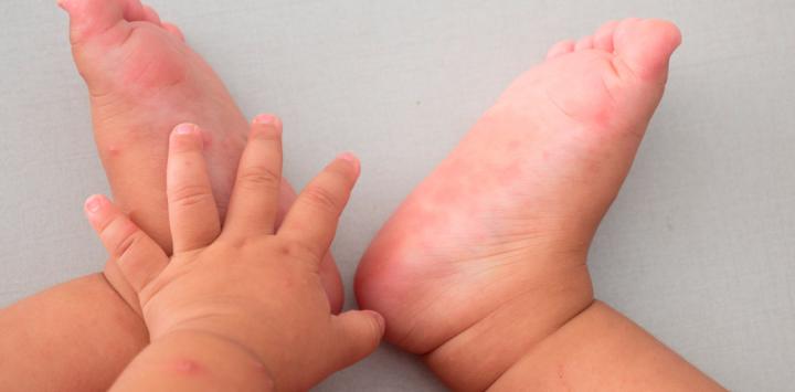 Virus de manos, pies y boca es monitoreado en la localidad