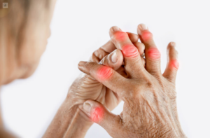 La Artritis Reumatoide afecta más a mujeres