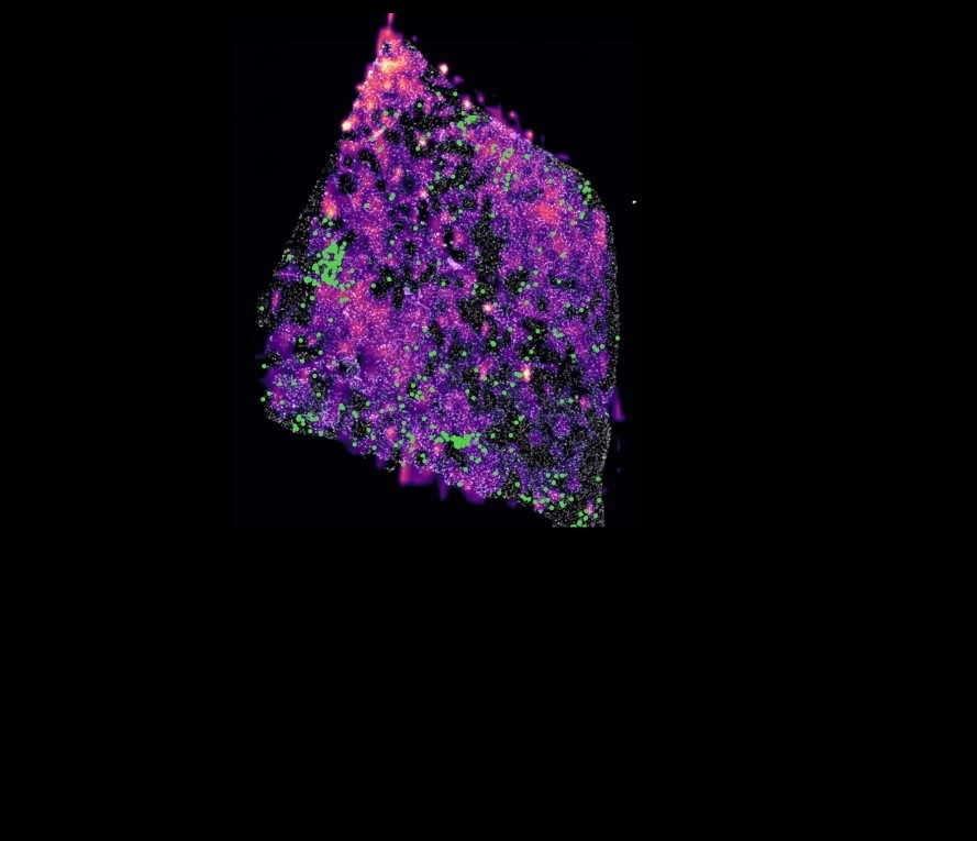 Tumor de glioma humano con una mutación que muestra grupos de células T en verde y cuyos puntos rosa representan concentraciones del metabolito D-2HG.