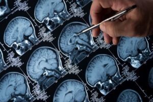Un estudio arroja luz sobre la razón por la que las personas con epilepsia suelen tener problemas de memoria