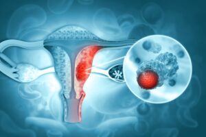 La IA revoluciona el diagnóstico temprano del cáncer de ovario