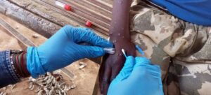 Brasil confirma su primer caso de la nueva variante de mpox